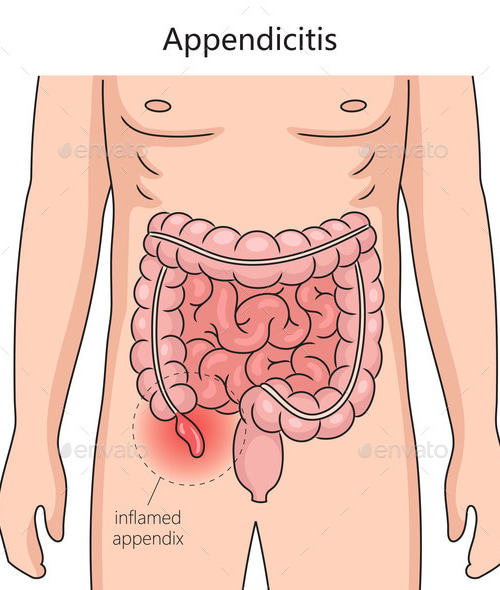 Appendicitis Inflammation of Appendix Medical, Vectors | GraphicRiver