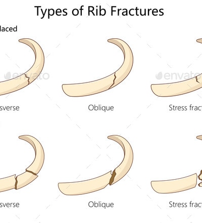 Types of Rib Fractures Diagram Medical Science, Graphics | GraphicRiver