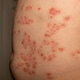 Skin patches exhibiting characteristics of psoriasis on the abdomen of an adult under natural Skin patches exhibiting characteristics of psoriasis on the abdomen of an adult under natural - PhotoDune Item for Sale