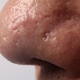 Macro close up of facial skin and nose. showing visible pores blackheads acne Macro close up of facial skin and nose. showing visible pores blackheads acne - PhotoDune Item for Sale